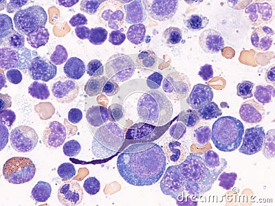 Systemic mastocytosis in bone marrow. Stock Photo