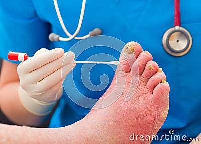 Taking Sample From Nail Fungus Stock Photo