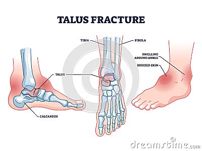 Talus fracture and broken leg with swelling ankle symptom outline diagram Vector Illustration