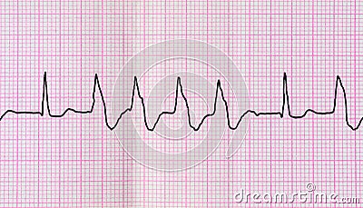 Tape ECG with group ventricular extrasystoles Stock Photo