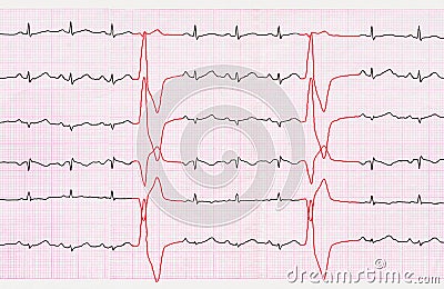 Tape ECG with ventricular premature beats (quadrigemini) Stock Photo