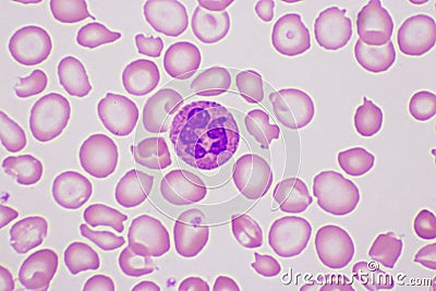 Target cells with abnormal red blood cells Stock Photo