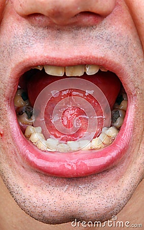 Tartar and amalgam fillings Stock Photo