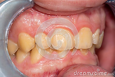 Tartar close-up on the lower anterior incisors. Dental hygiene of teeth Stock Photo