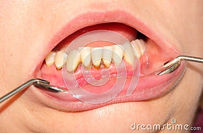 Tartar and dental plaque Stock Photo