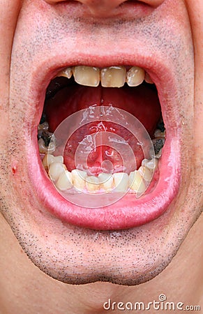 Tartar and tooth decay Stock Photo