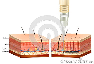 The Tattooing Process. Tattoo Pigment under skin of Epidermis and Dermis. Vector Illustration