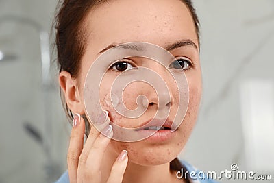 Teen girl applying acne healing patch indoors Stock Photo