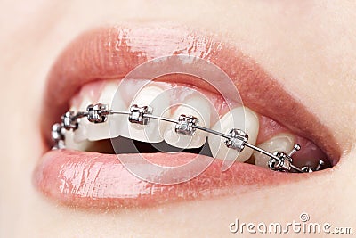 Teeth with braces Stock Photo