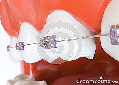 Teeth with braces or brackets in open human mouth - 3d rendering Stock Photo