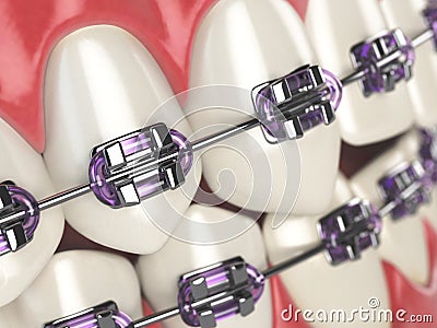 Teeth with braces or brackets in open human mouth. Dental care c Cartoon Illustration