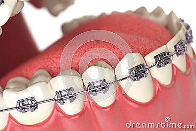 Teeth with braces or brackets in open human mouth. Dental care c Cartoon Illustration