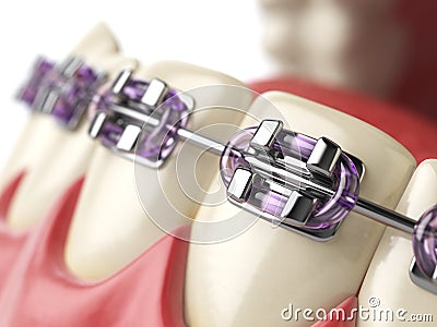 Teeth with braces or brackets in open human mouth. Dental care Cartoon Illustration