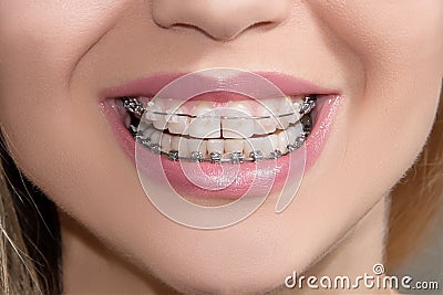 Teeth with braces Stock Photo