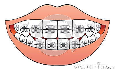 Teeth with braces Vector Illustration