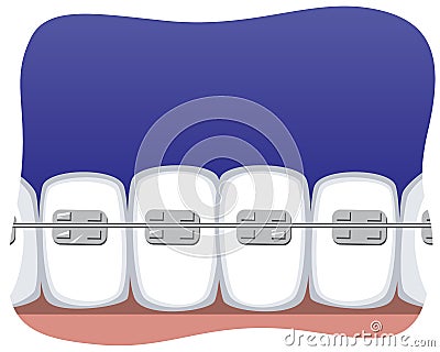 Teeth with braces and space for text or copy space, flat vector stock illustration with braces system as a concept of orthodontic Cartoon Illustration