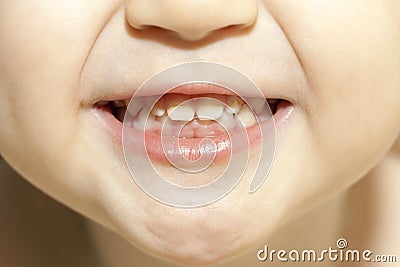 Teeth with caries Stock Photo