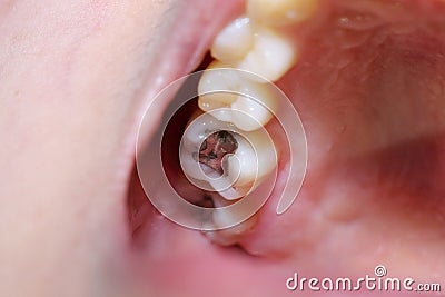 Teeth cavity with the treatment Stock Photo