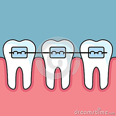 Teeth with dental braces - arrange Vector Illustration