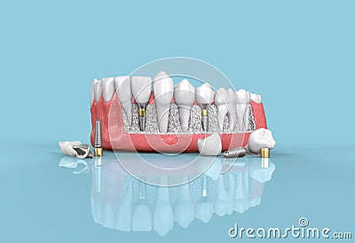 teeth dental implant model 3d illustration Cartoon Illustration