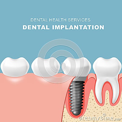 Teeth and dental implantat inserted into gum - tooth Vector Illustration