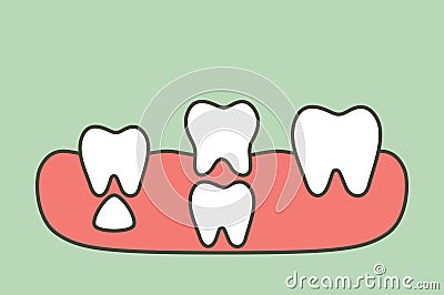 teeth are growing up from the gum by permanent tooth located below primary tooth, first tooth - dental cartoon vector flat style Vector Illustration