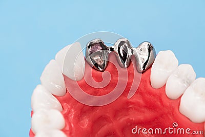 Teeth implant and crown installation process parts isolated on a blue background. Medically accurate 3D model. Stock Photo