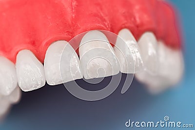 Teeth implant and crown installation process parts isolated on a blue background. Medically accurate 3D model. Stock Photo