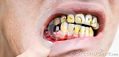 Teeth implantation. Dental post preparation. Medical problem Stock Photo