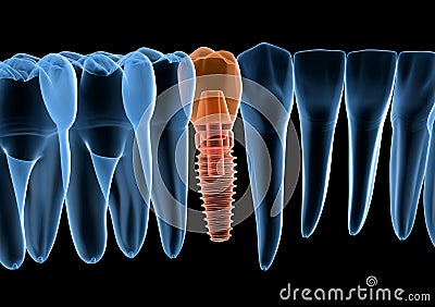 Teeth recovery with implant, x-ray view. Medically accurate 3D illustration of human teeth and dentures concept Cartoon Illustration