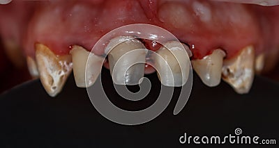 Teeth restored with the help of composite material and processed for prosthetics with crowns. Retraction of the gums. Stock Photo