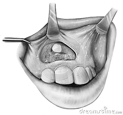 Teeth - Surgical Exposure of Impacted Incisor Stock Photo