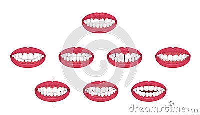 Teeth trouble bite type / crooked teeth vector illustration set Vector Illustration