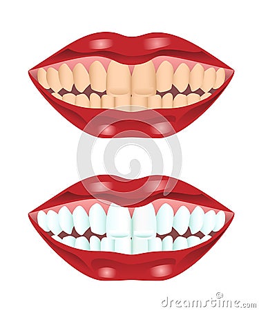 Teeth before and after whitening Vector Illustration