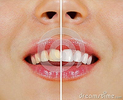 Teeth before and after whitening Stock Photo