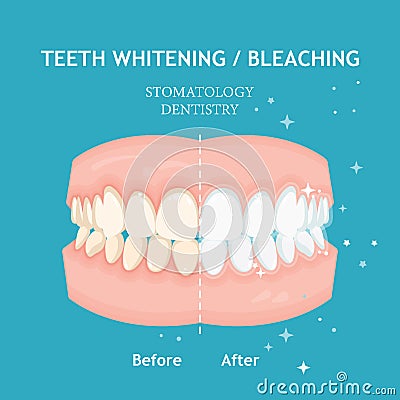 Teeth whitening and bleaching concept. Dentistry and stomatology vector Vector Illustration