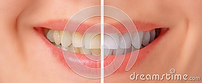 Teeth before and after whitening Stock Photo