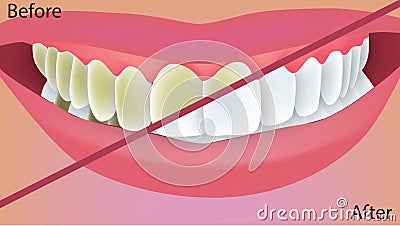 Teeth whitening Cartoon Illustration