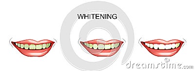 Teeth whitening. dentistry Vector Illustration