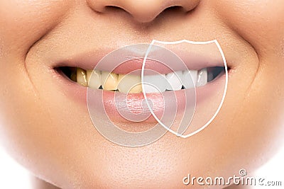 Teeth whitening and hygiene. Result after treatment in professional dental clinic. Stock Photo