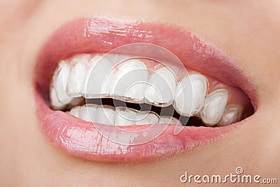 Teeth with whitening tray Stock Photo