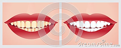 Teeth whitening Cartoon Illustration