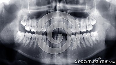 Teeth x-ray Stock Photo