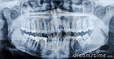 Teeth x-ray Stock Photo