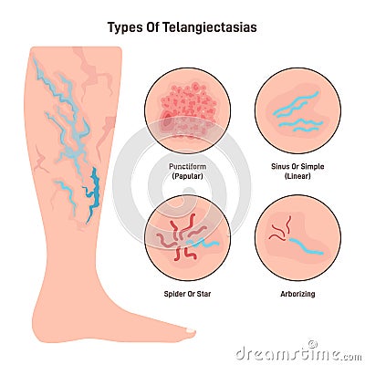 Telangiectasia types set. Varicose veins pattern, dilated blood vessels Vector Illustration