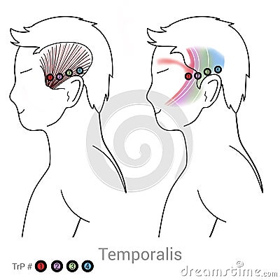 Temporalis: Managing headache pain arriving from myofascial trigger points in the Temporalis Cartoon Illustration