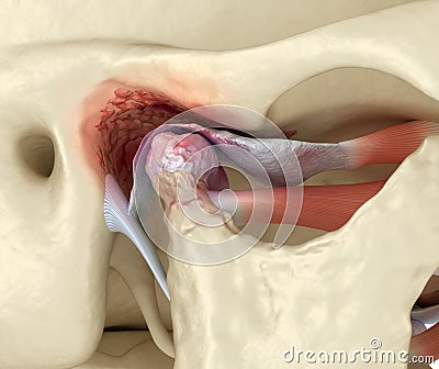 Temporomandibular joints arthritis and dislocated articular disc. Medically accurate 3D illustration Cartoon Illustration