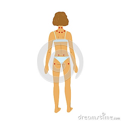 Tenders points of fibromyalgia. Vector illustration of woman body on white background. Vector Illustration