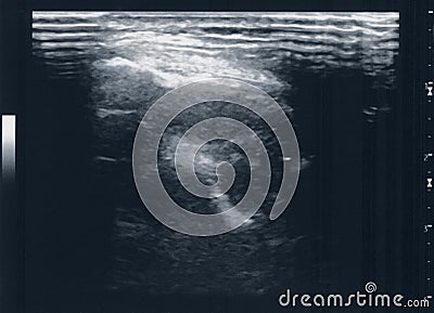 Tendon muscle ultrasound sonography Stock Photo