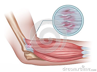 Lateral epicondylitis Cartoon Illustration